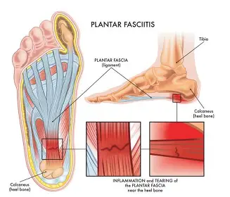 Plantar Fasciitis